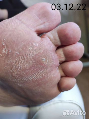 Подолог, педикюр, вросший ноготь, бородавка