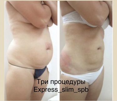 Криолиполиз New система липосакции